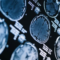 Anti-amyloid Alzheimer’s drugs show no clinically meaningful effect